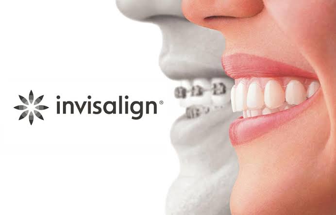 Aligners Treatment